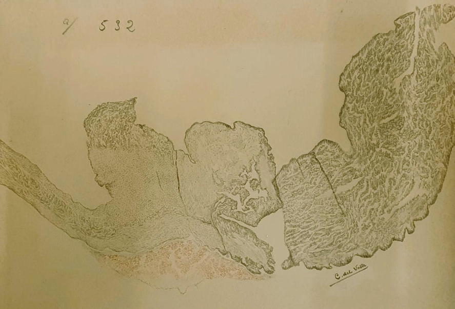 Primer dibujo conocido de Conchita del Valle. Ilustración realizada por Conchita del Valle a partir de un fragmento de una vegetación de la válvula mitral obtenida en el curso de la autopsia de una paciente con endocarditis lenta de origen estreptocócico. Realizado en 1930. Fuente:  Baquero et al., 2022. Disponible en: http://gesdoc.isciii.es/gesdoccontroller?action=download&id=29/06/2022-1ed6789b30. Fuente https://santiagoramonycajal.org/2025/04/26/conchita-del-valle/